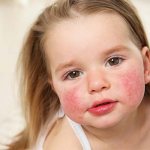 Аллергия у ребенка во сне