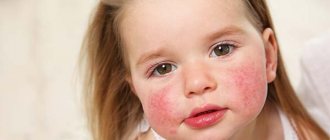 Аллергия у ребенка во сне