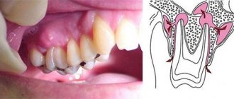 Periostitis (flux on the gum, cheek, tooth)