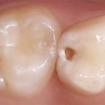 Dream interpretation hole in tooth