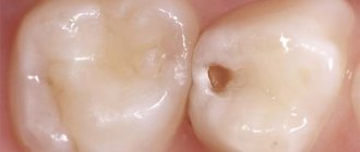 Сонник дырка в зубе