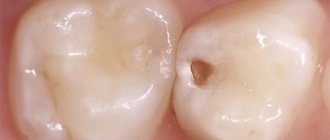 Dream interpretation hole in tooth